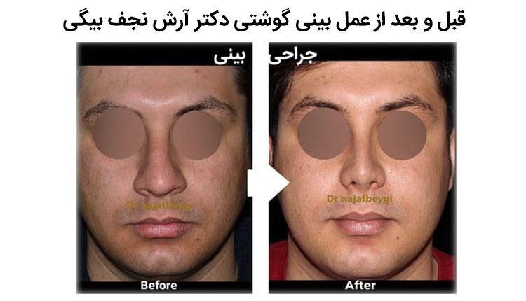 دکتر آرش نجف بیگی قبل و بعد از عمل بینی