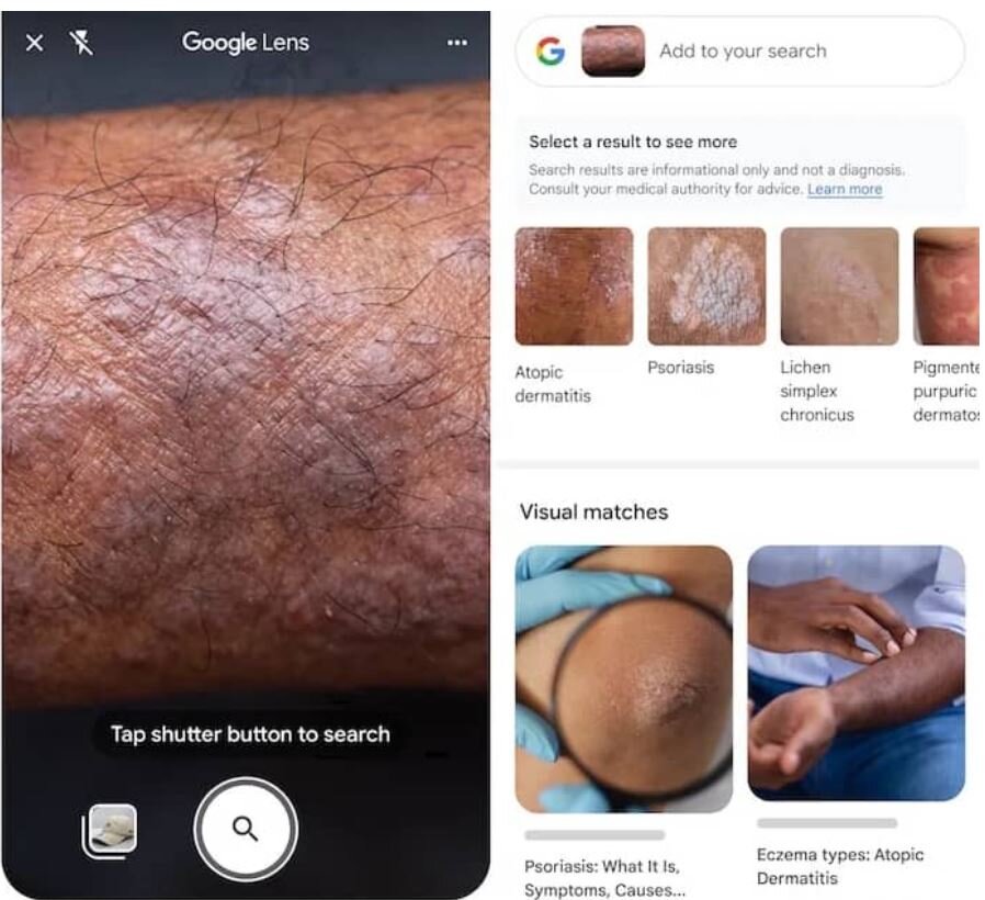 گوگل لنز در نقش دکتر پوست/ عکس