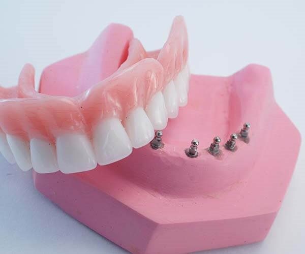 ایمپلنت دندان آپارات | ایمپلنت دندان آسیا | ایمپلنت دندان آسیاب