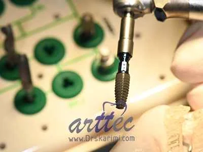 ایمپلنت Why do implant teeth turn black