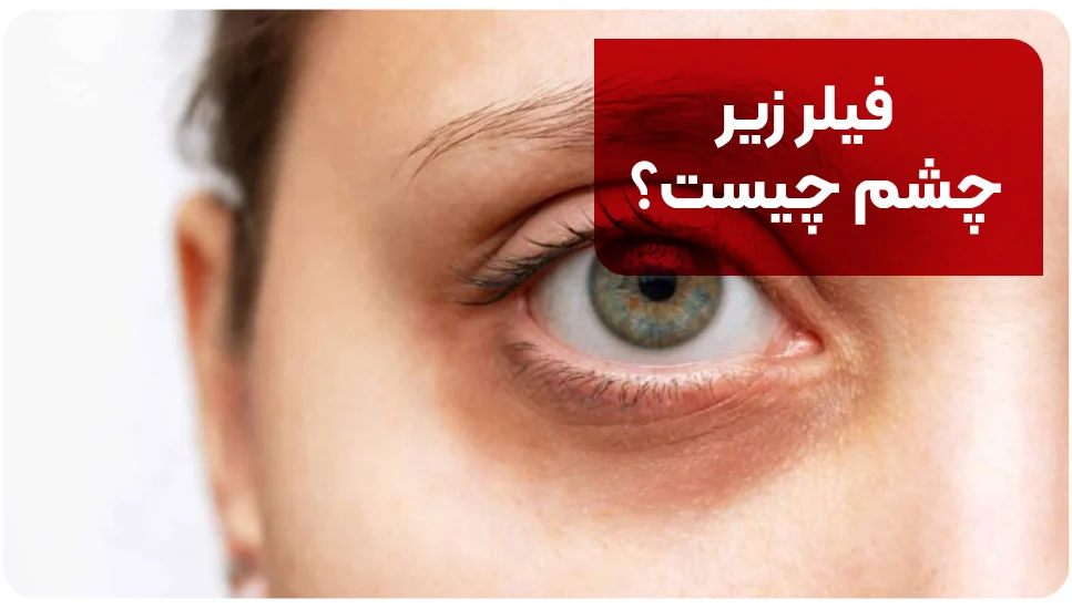 فیلر زیر چشم چیست؟