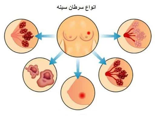سرطان | سرطان سینه