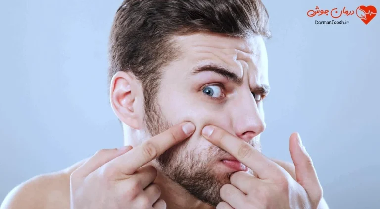 بهترین صابون طبیعی برای درمان جوش صورت در خانه چیست؟