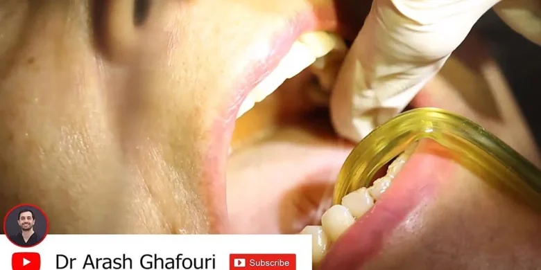 ایمپلنت