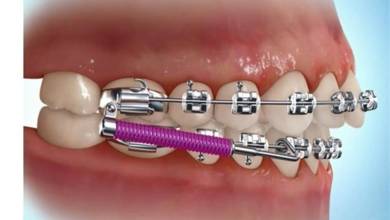 درمان ارتودنسی | کامپوزیت دندان‌ | کلینیک پزشکی