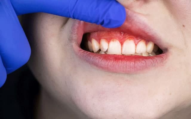 درمان خانگی خونریزی لثه بعد از کشیدن دندان | درمان خونریزی لثه در طب سنتی | درمان خونریزی لثه و بوی بد دهان