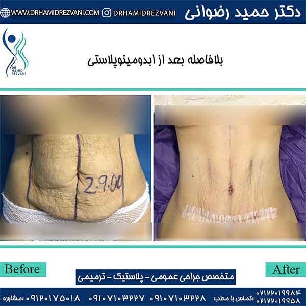 Recovery period after abdominoplasty