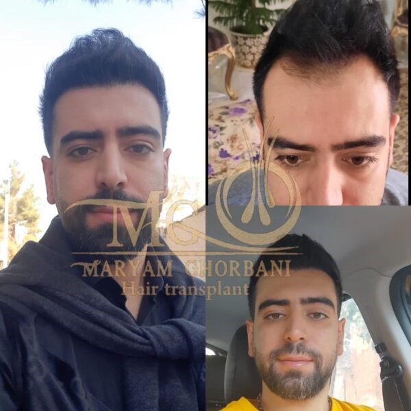 جدیدترین روش کاشت مو بدون بانک مو | جدیدترین روش کاشت مو در ایران | جدیدترین روش کاشت مو در جهان