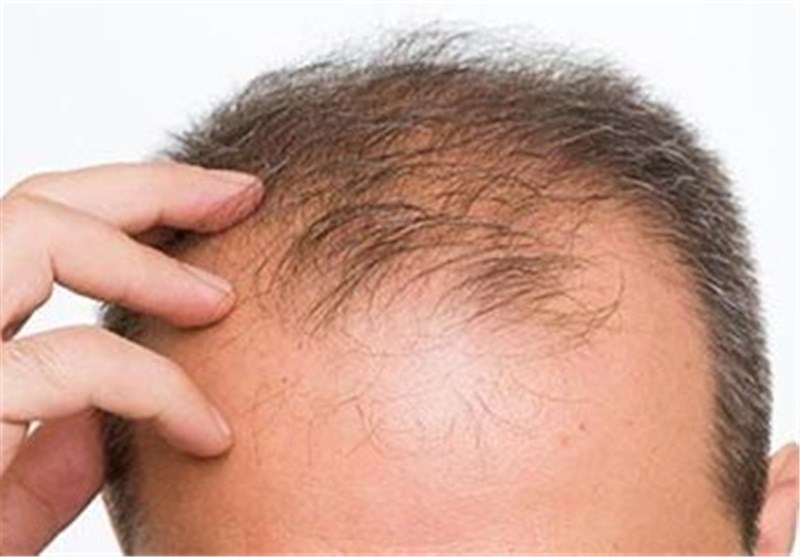 درمان ریزش مو | مردان و زنان