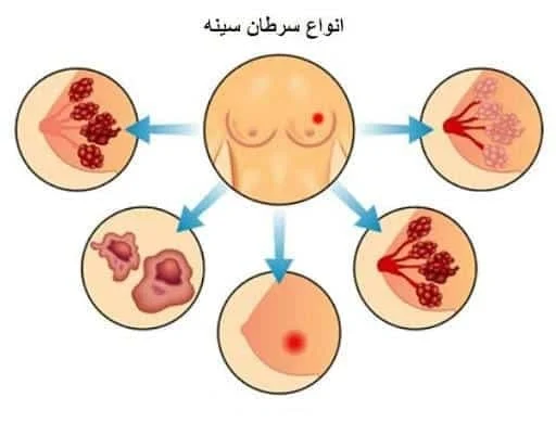 سرطان | سرطان سینه