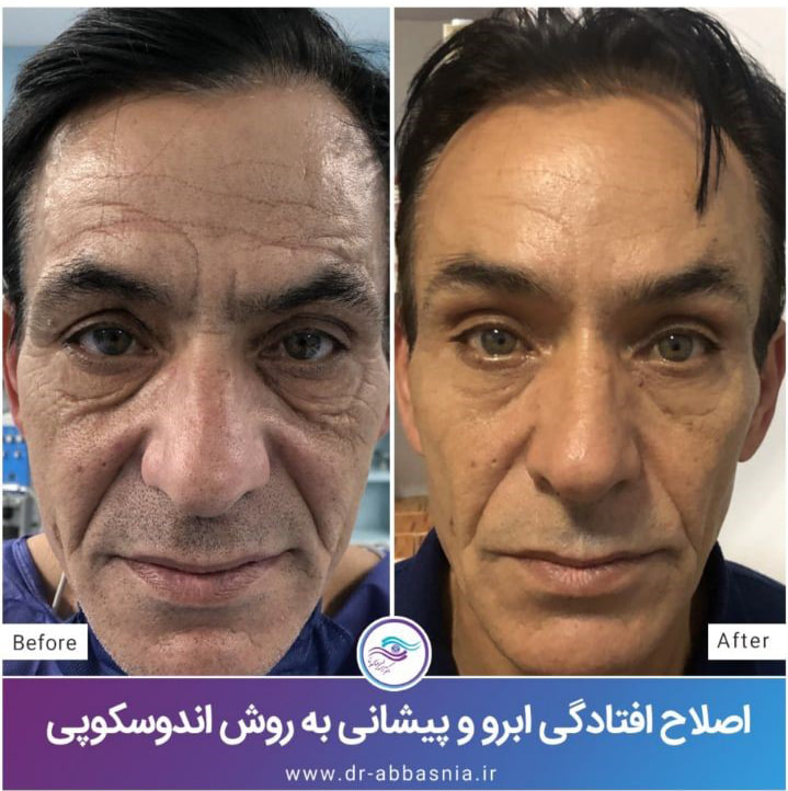 بلفاروپلاستی | پوست | جراحی بلفاروپلاستی | پوست | جراحی