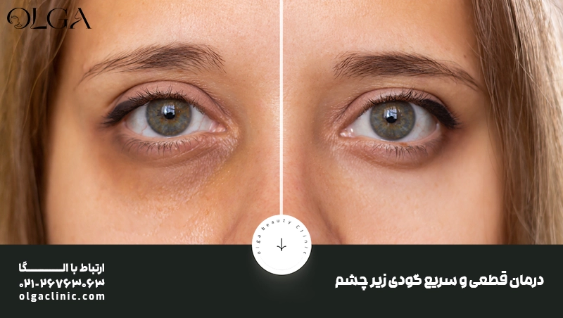 آلرژی | پوست | تغذیه درمان قطعی و سریع گودی زیر چشم