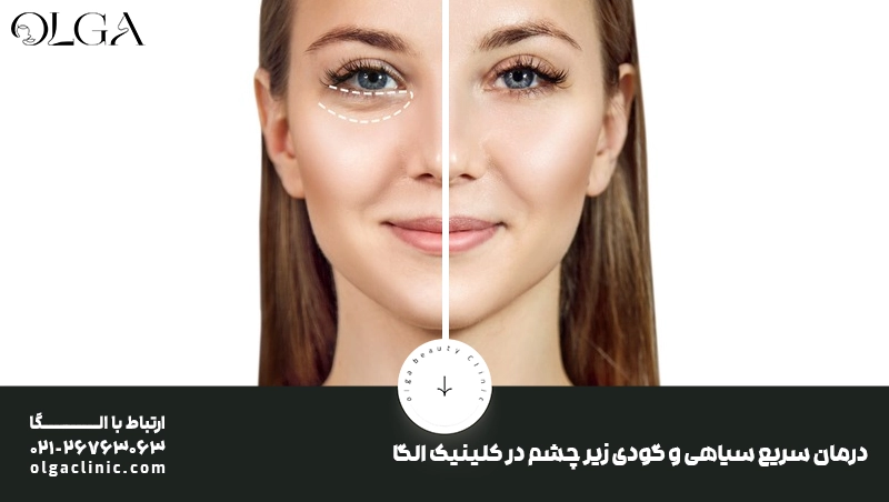 آلرژی | پوست | تغذیه درمان سریع سیاهی و گودی زیر چشم در کلینیک الگا